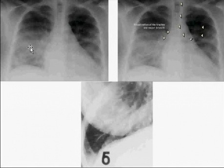 Hemodynamic Disorders, Thromboembolic Disease and Shock - MSP - 4c