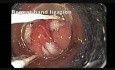 Colonoscopy - Rectal Polyp with Cancer - EMR of the Scar for Staging