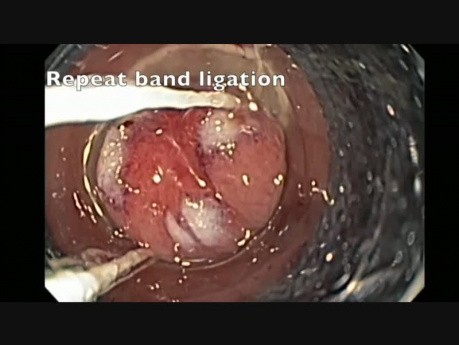 Colonoscopy - Rectal Polyp with Cancer - EMR of the Scar for Staging