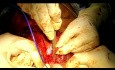TEP Insertion Post Laryngectomy