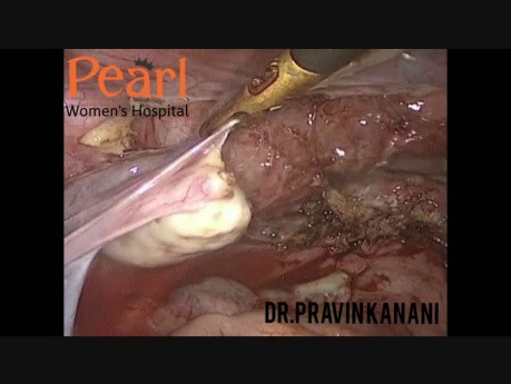 RV Nodules Excision With TLH