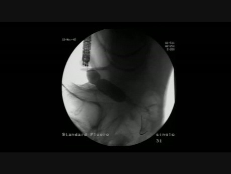 Colonoscopy Channel - Management Of Colon Obstruction - Dilation Of Anastomotic Stricture
