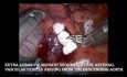 Extralobar Pulmonary Sequestration