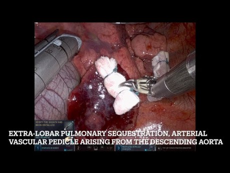 Extralobar Pulmonary Sequestration