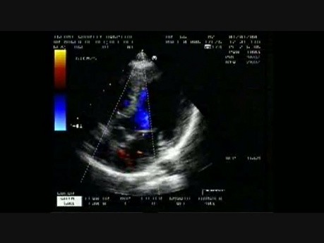 Combined Shunt: Ostium Secundum asd And Perimembranous vsd 