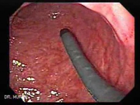 Adenocarcinoma of the Gastroesophageal Junction - Introduction of Two Endoscopes
