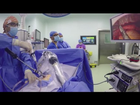 Uniportal Unisurgeon VATS Lobectomy (Robotic Arm, No Assistant)