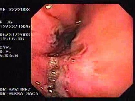 Upper Gastrointestinal Bleeding (11 of 15)
