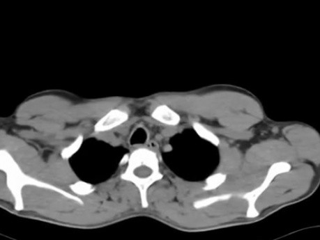 Circular resection of trachea