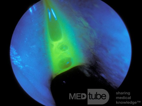 The Fluorescein Test For CSF Rhinorrhea