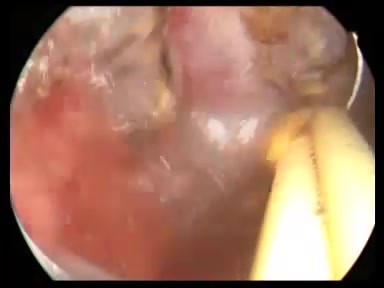 Adenomyosis - endometrial ablation