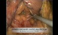 Laparoscopic Whipple - Pancreatic Duodenectomy