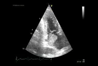 Myxoma In Echocardiography