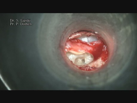 Surgical Revision of an Inefficient TORP on the Right Ear