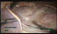 18cm Size Broad Ligament Fibroid Arising from Isthamus