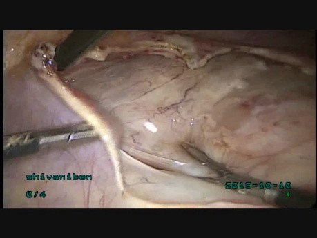 18cm Size Broad Ligament Fibroid Arising from Isthamus