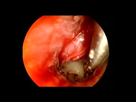 Endoscopic Stapedotomy