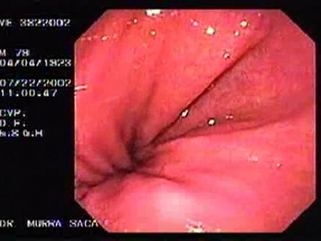 Small Paraesophageal Hernia