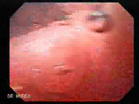 Familial Adenomatous Polyposis of the Colon (28 of 29)
