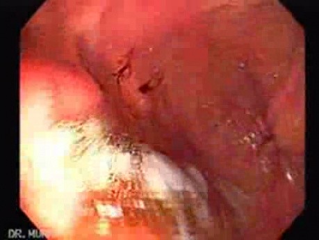 Hereditary Hemorrhagic Telangiectasia (Osler-Weber-Rendu syndrome) (5 of 7)