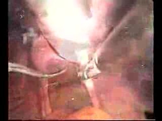 Total Laparoscopic Hysterectomy (TLH) And Bilateral Adnexectomy
