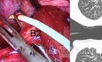 VATS S2 Right Segmentectomy