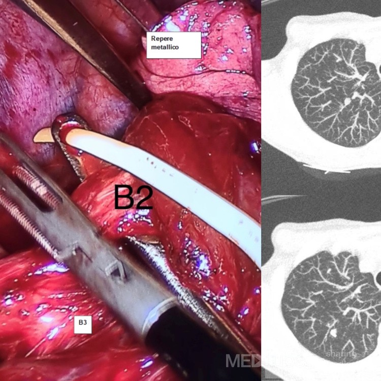 VATS S2 Right Segmentectomy