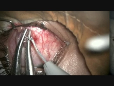 How to do Inferior Oblique Myomectomy