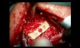 Revision Surgery on the Cervical Spine