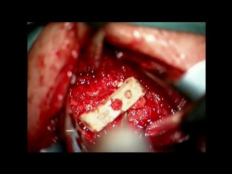 Revision Surgery on the Cervical Spine