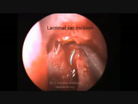 Endoscopic DCR