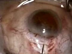 Cataract Surgery