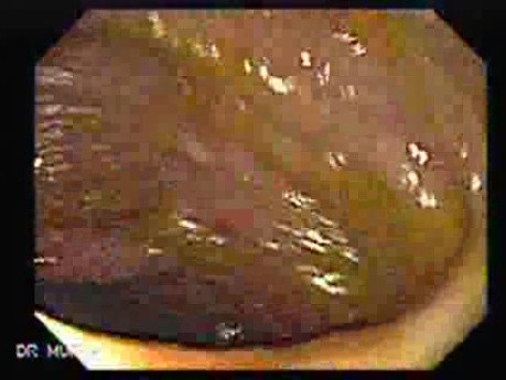 Rectum (21 of 30)