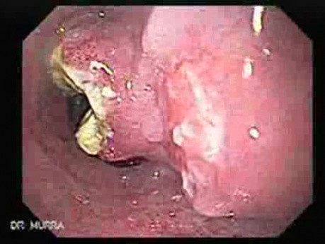 Small Cell Carcinoma of the Lung that Invades the Upper and the Middle Third of the Esophagus - Presentation of the Middle Third of the Esophagus