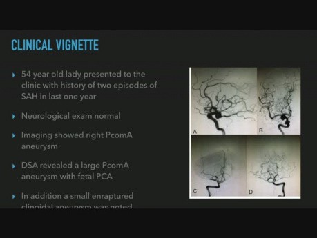 Management of Posterior Communicating Artery Aneurysm in the Presence of Fetal Variant of Posterior Cerebral Artery