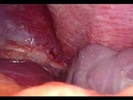 Colonic Perforation With Peritonitis - Laparoscopy (37 of 46)