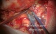 Rare Location of Intracranial Aneurysm - Posterior Cerebral Artery (PCA) in  P1 / P2 Segment