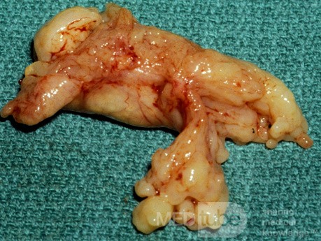 Large Inverting Papilloma [Surgical Specimen]