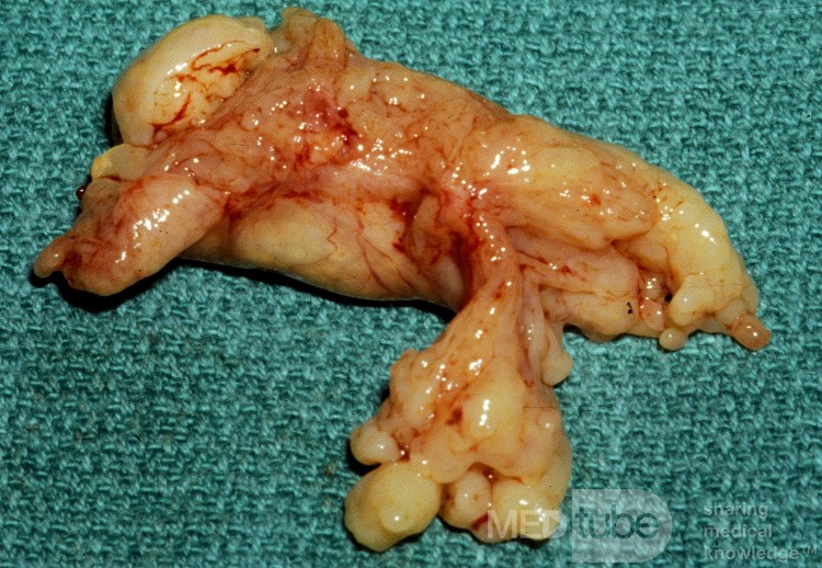 Large Inverting Papilloma [Surgical Specimen]