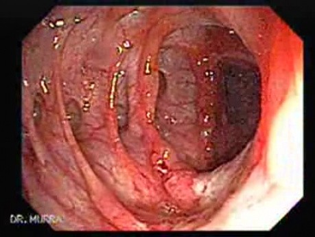 Severe case of Ischemic Colitis (10 of 19)