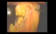 Surgical Laparoscopic Liberation Of Peritoneal Adhesions
