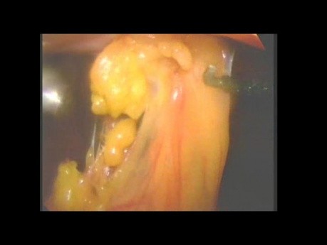 Surgical Laparoscopic Liberation Of Peritoneal Adhesions