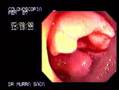 Rectum - Adenocarcinoma - Endoscopy