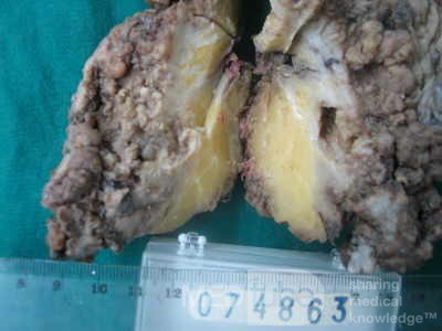 Synchronous Cancers, Familial Adenomatous Polyposis (35 of 36)