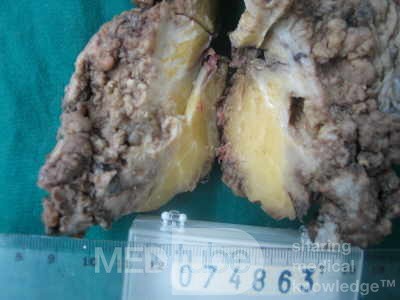 Synchronous Cancers, Familial Adenomatous Polyposis (35 of 36)