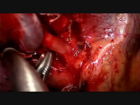 First Non Intubated VATS Lobectomy in UK (single port approach)