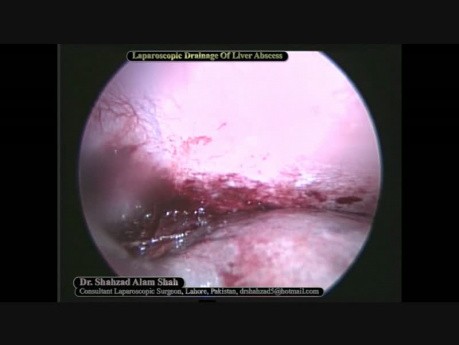 Laparoscopic Liver Abscess Drainage