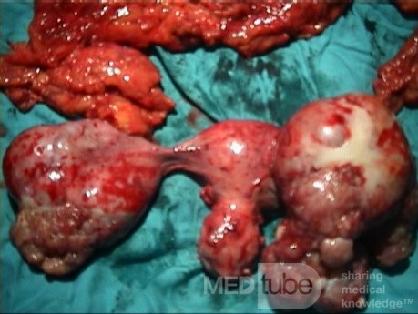 Cancer Ovary Radical Surgery