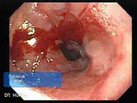 Pneumatic Dilation for Achalasia - Assessment of the Lower Third of Esophagus
