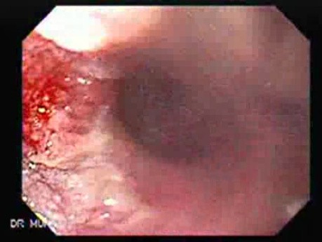 Esophageal Squamous Cell Carcinoma of the the Upper Third of the Esophagus - 83 Year-Old Male